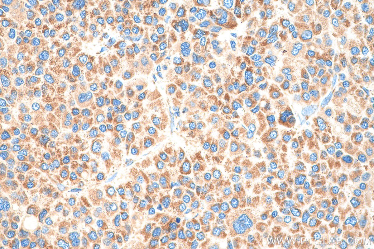 Immunohistochemistry (IHC) staining of human liver cancer tissue using NDUFS1 Polyclonal antibody (12444-1-AP)