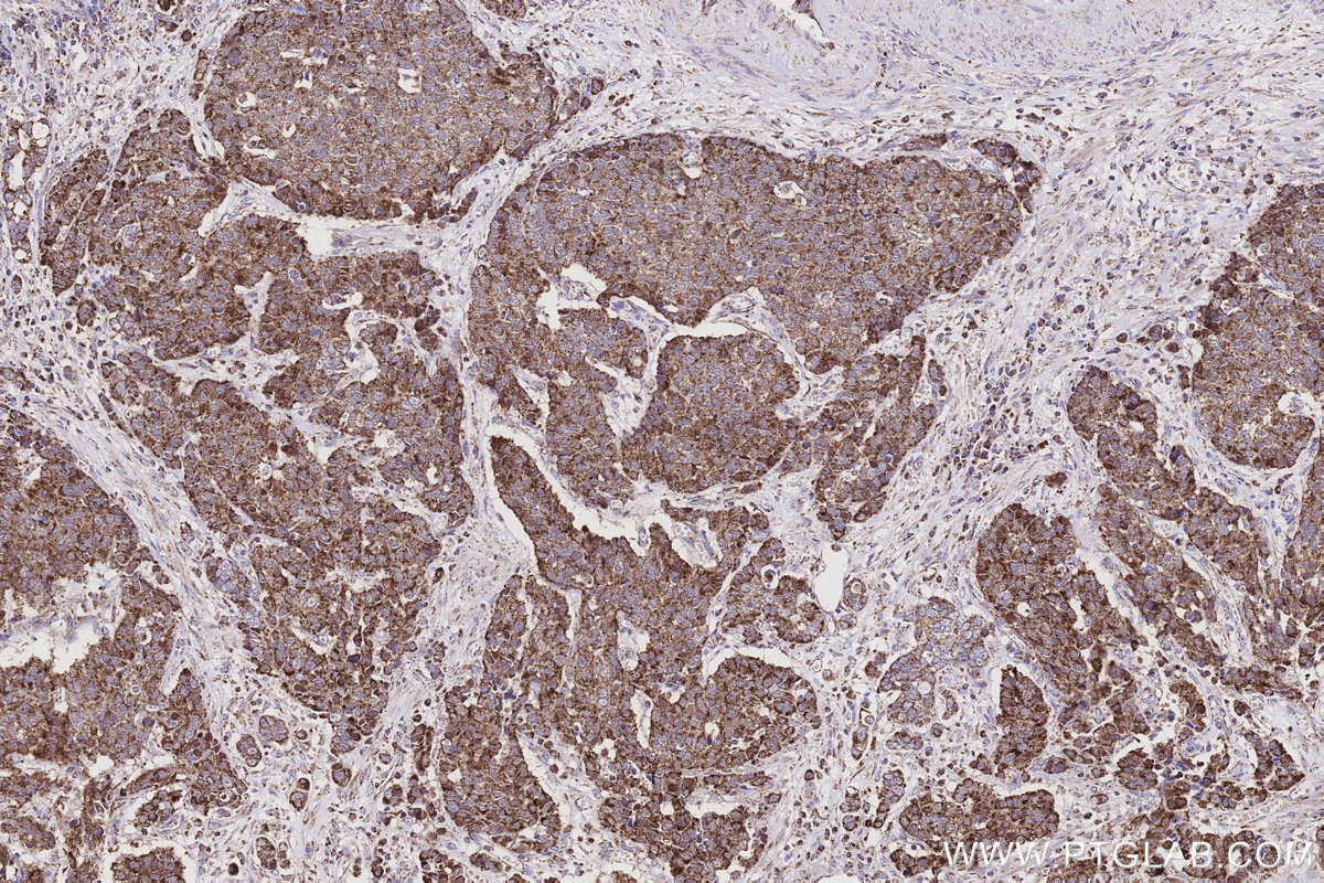 IHC staining of human stomach cancer using 28125-1-AP Immunohistochemistry (IHC) staining of human stomach cancer tissue using NDUFS2 Polyclonal antibody (28125-1-AP)
