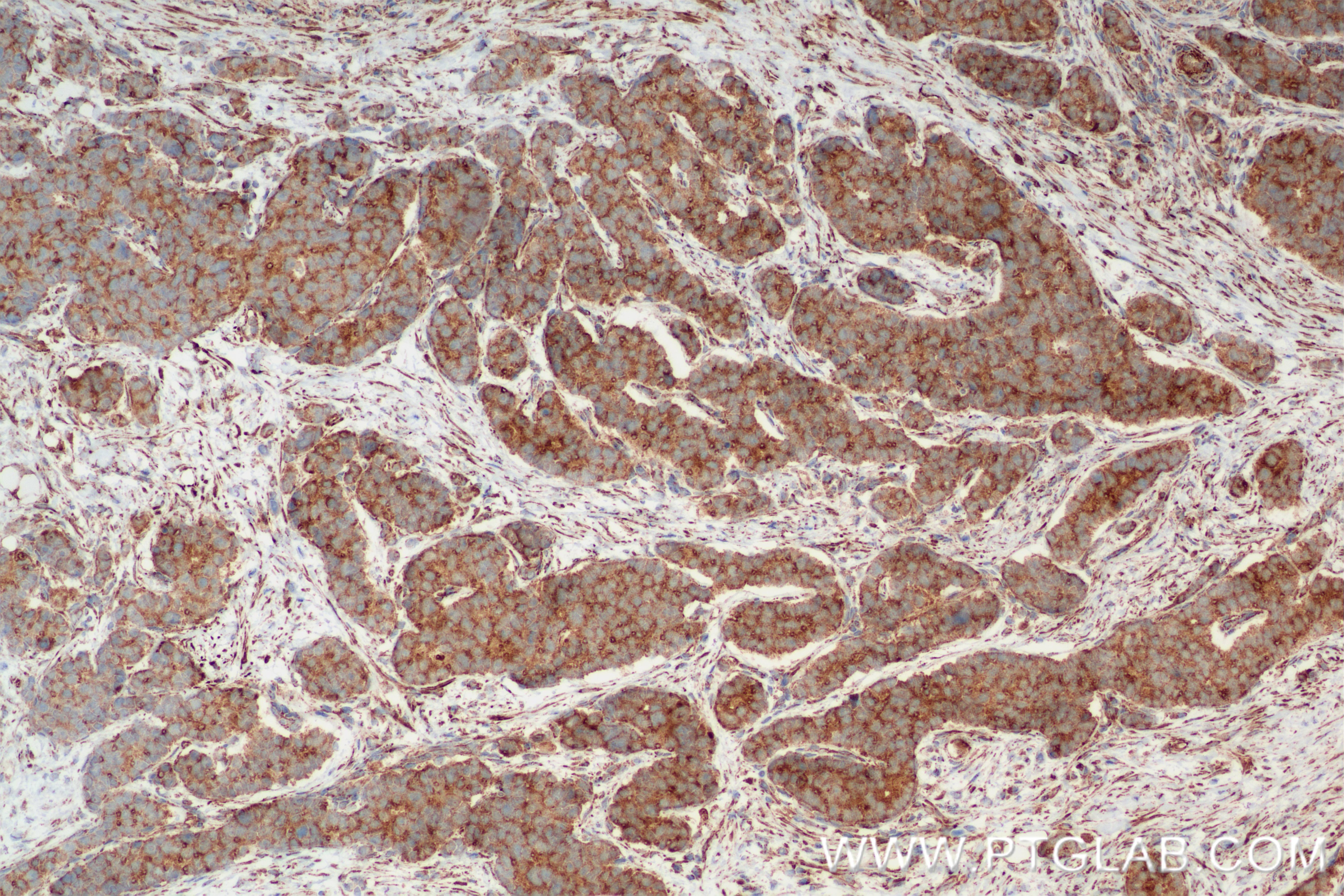 Immunohistochemistry (IHC) staining of human stomach cancer tissue using NDUFS2 Recombinant antibody (84880-1-RR)