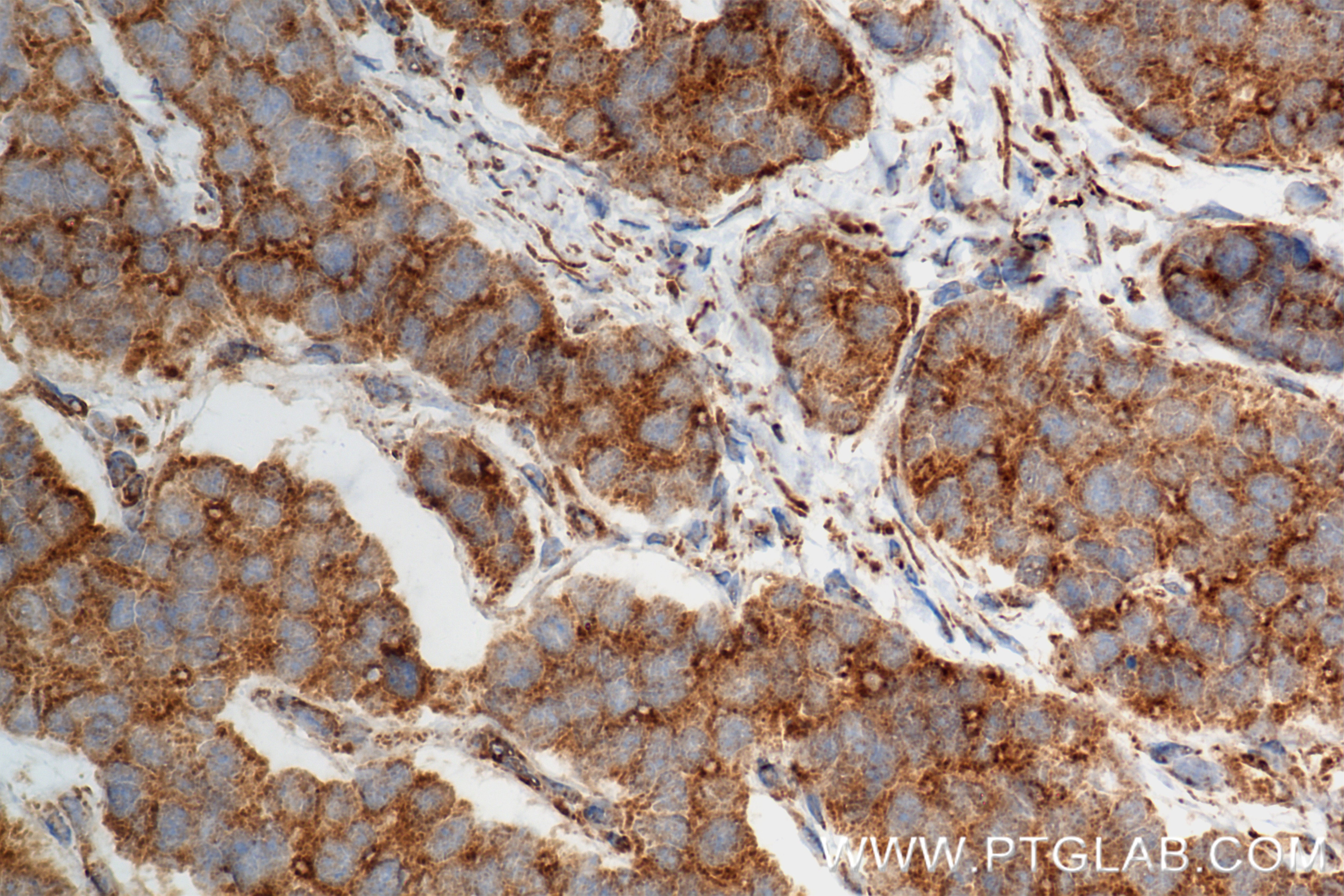 Immunohistochemistry (IHC) staining of human stomach cancer tissue using NDUFS2 Recombinant antibody (84880-1-RR)