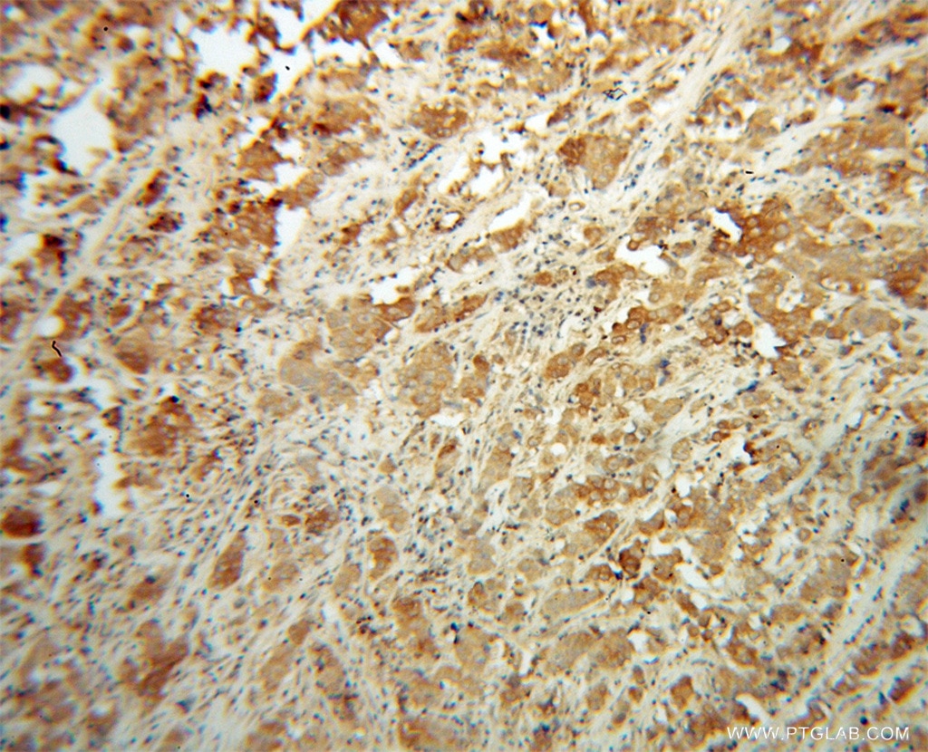 Immunohistochemistry (IHC) staining of human prostate cancer tissue using NDUFS6 Polyclonal antibody (14417-1-AP)