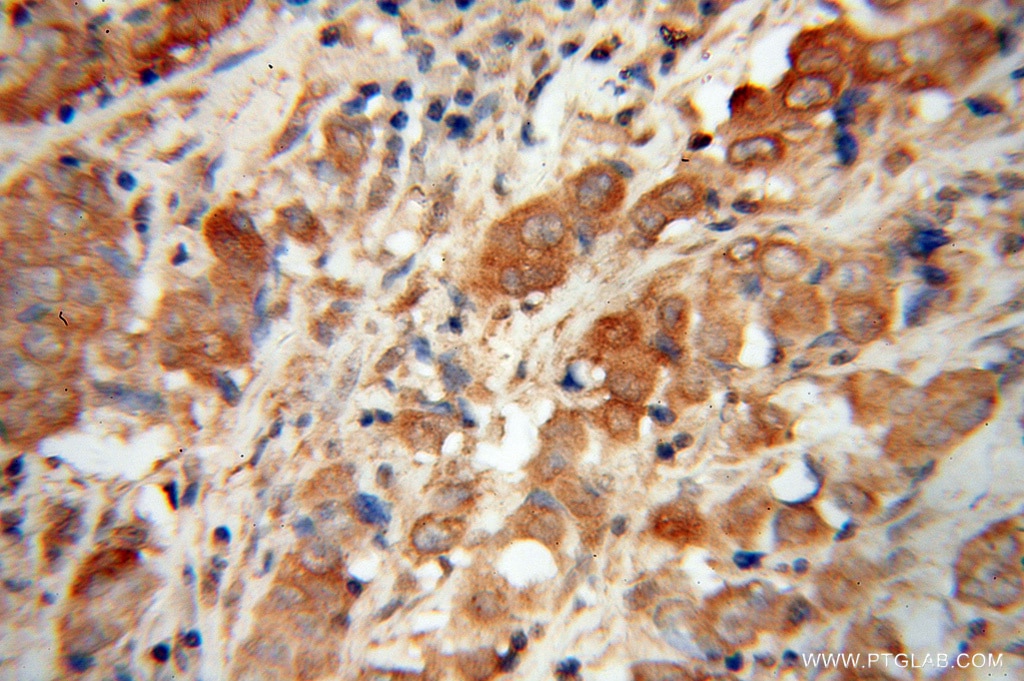 Immunohistochemistry (IHC) staining of human prostate cancer tissue using NDUFS6 Polyclonal antibody (14417-1-AP)