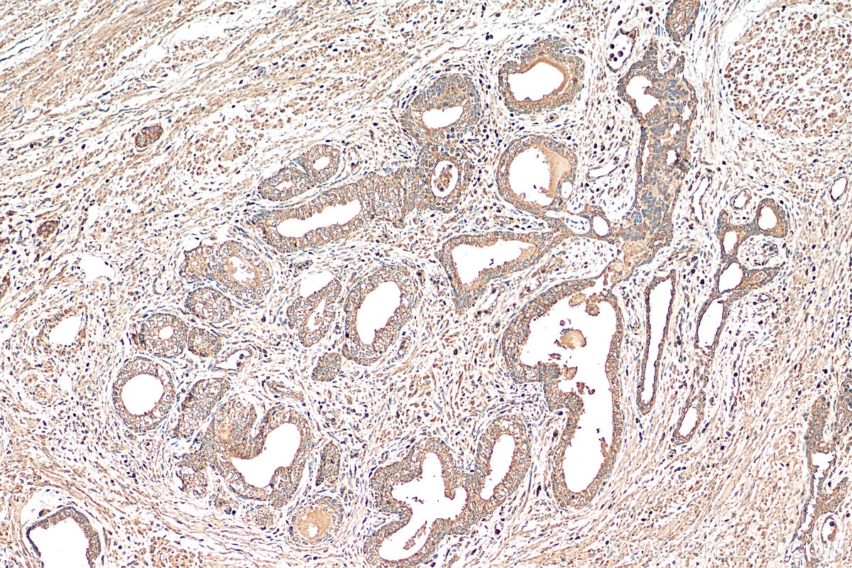 Immunohistochemistry (IHC) staining of human prostate cancer tissue using NDUFS6 Monoclonal antibody (68329-1-Ig)