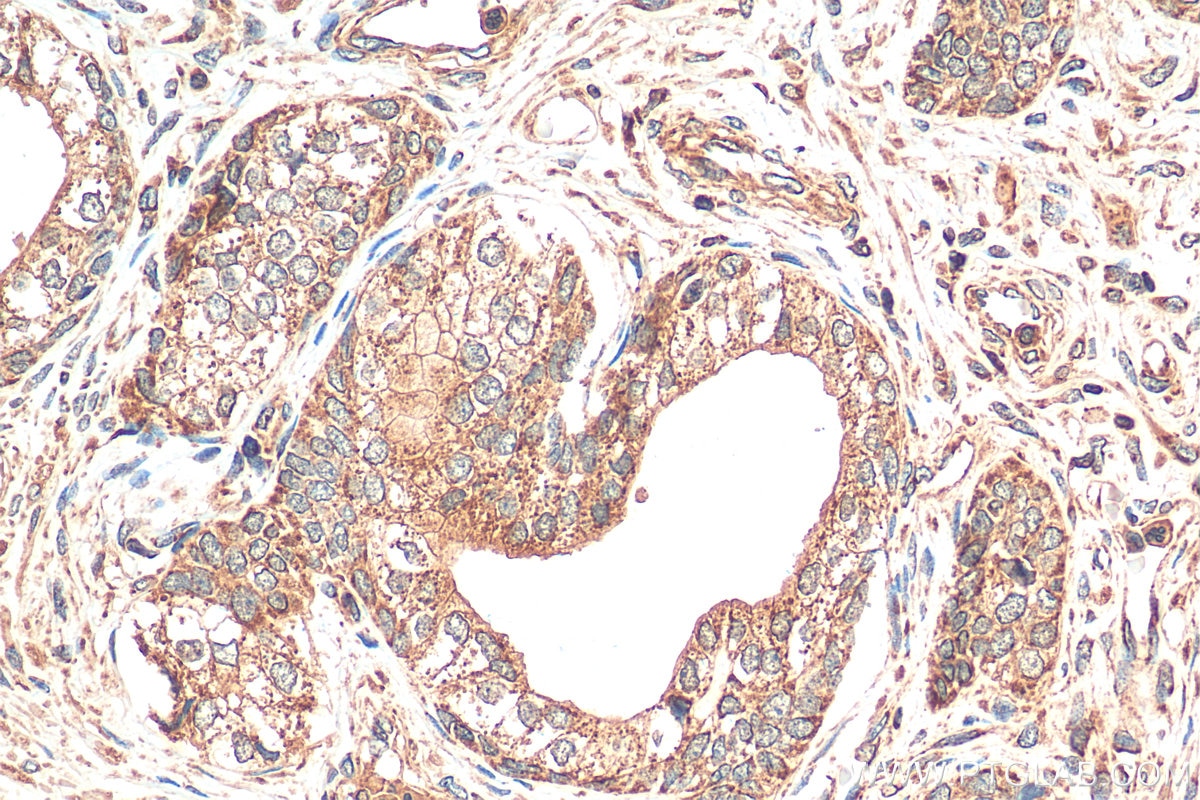 Immunohistochemistry (IHC) staining of human prostate cancer tissue using NDUFS6 Monoclonal antibody (68329-1-Ig)