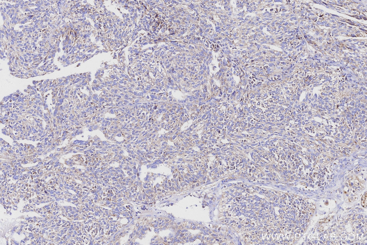 Immunohistochemistry (IHC) staining of human ovary cancer tissue using NDUFS6 Monoclonal antibody (68329-1-Ig)