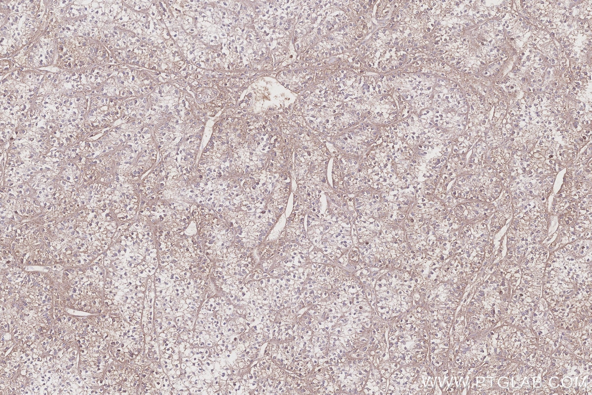 IHC staining of human renal cell carcinoma using 15728-1-AP Immunohistochemistry (IHC) staining of human renal cell carcinoma tissue using NDUFS7 Polyclonal antibody (15728-1-AP)