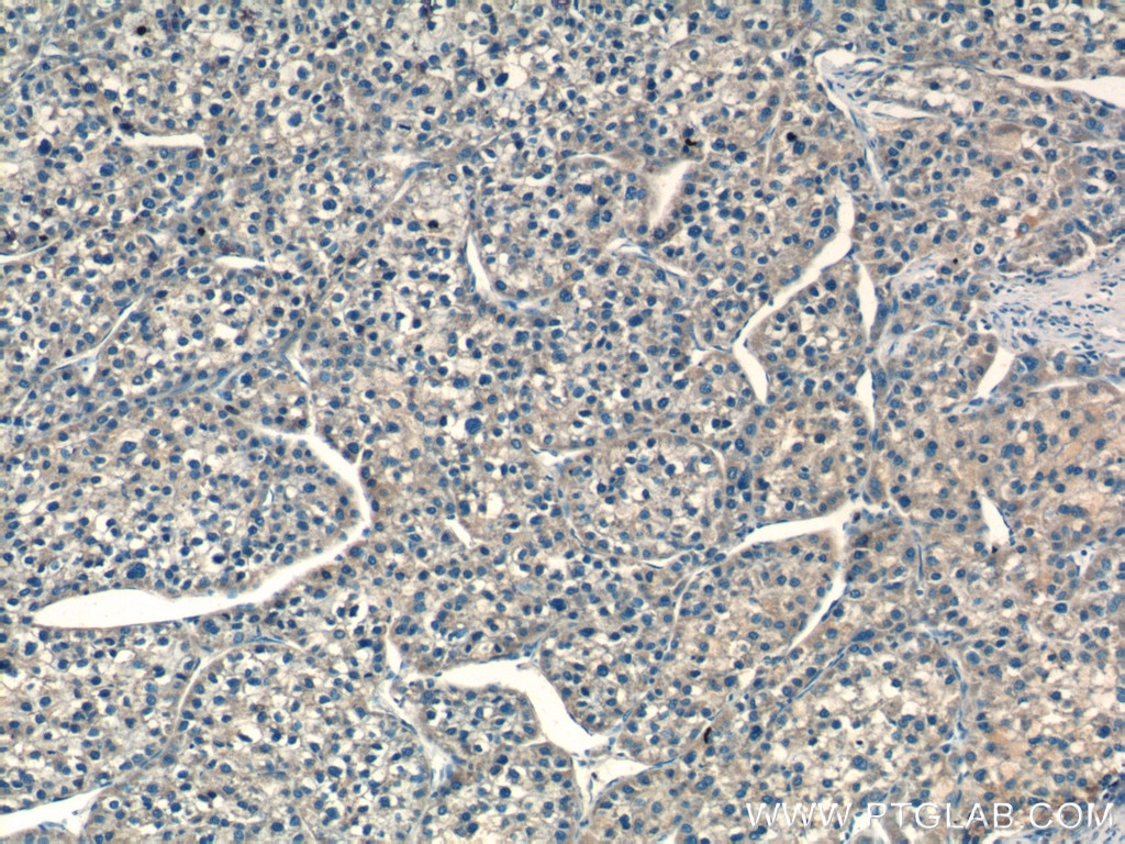 Immunohistochemistry (IHC) staining of human liver cancer tissue using NDUFS8 Polyclonal antibody (25172-1-AP)