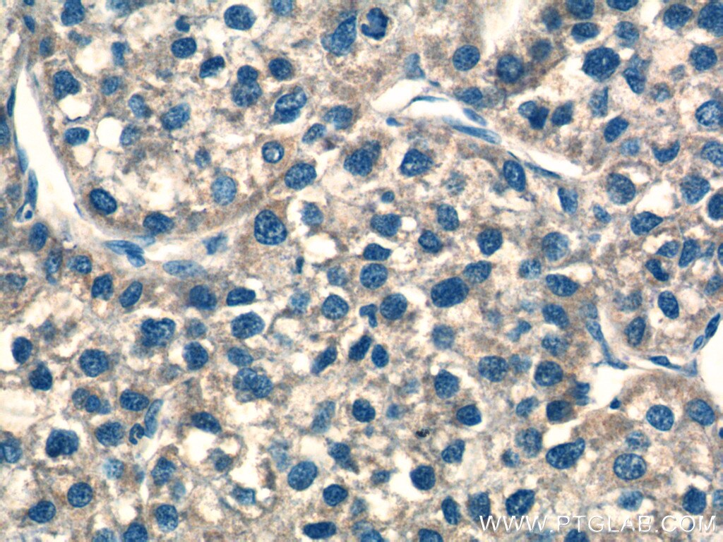 Immunohistochemistry (IHC) staining of human liver cancer tissue using NDUFS8 Polyclonal antibody (25172-1-AP)