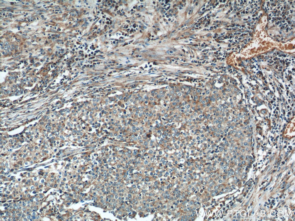 Immunohistochemistry (IHC) staining of human lung cancer tissue using NDUFV1 Polyclonal antibody (11238-1-AP)