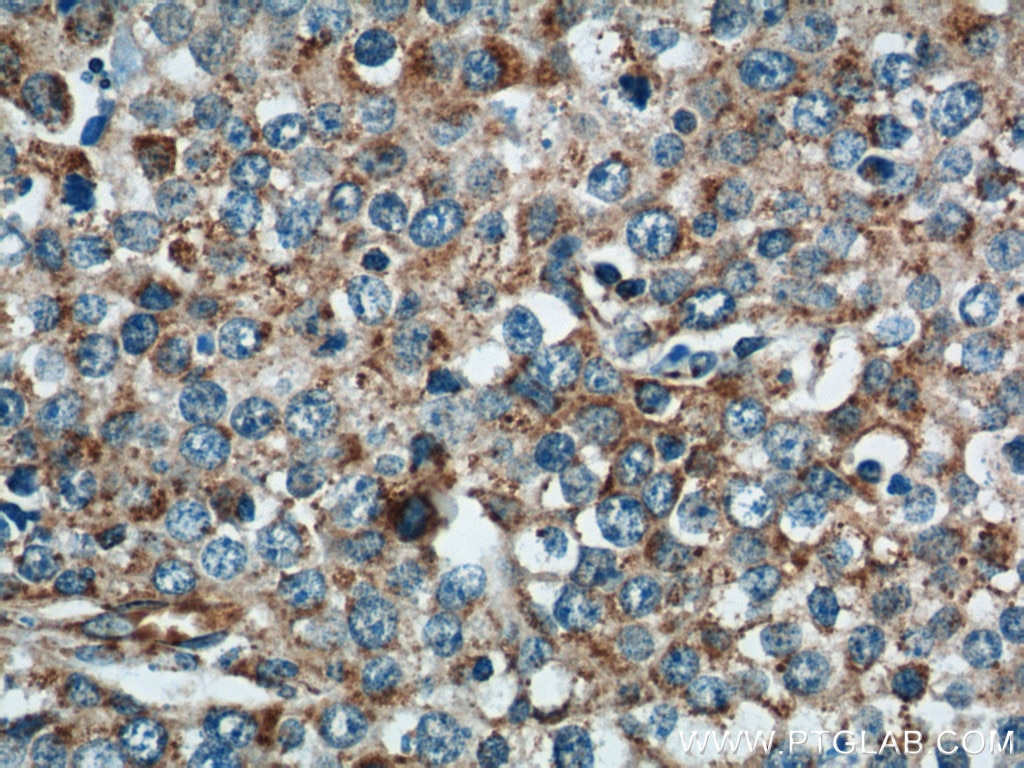Immunohistochemistry (IHC) staining of human lung cancer tissue using NDUFV1 Polyclonal antibody (11238-1-AP)