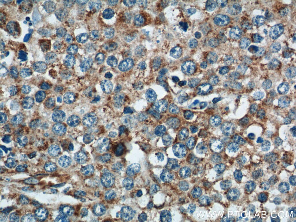 IHC staining of human lung cancer using 11238-1-AP