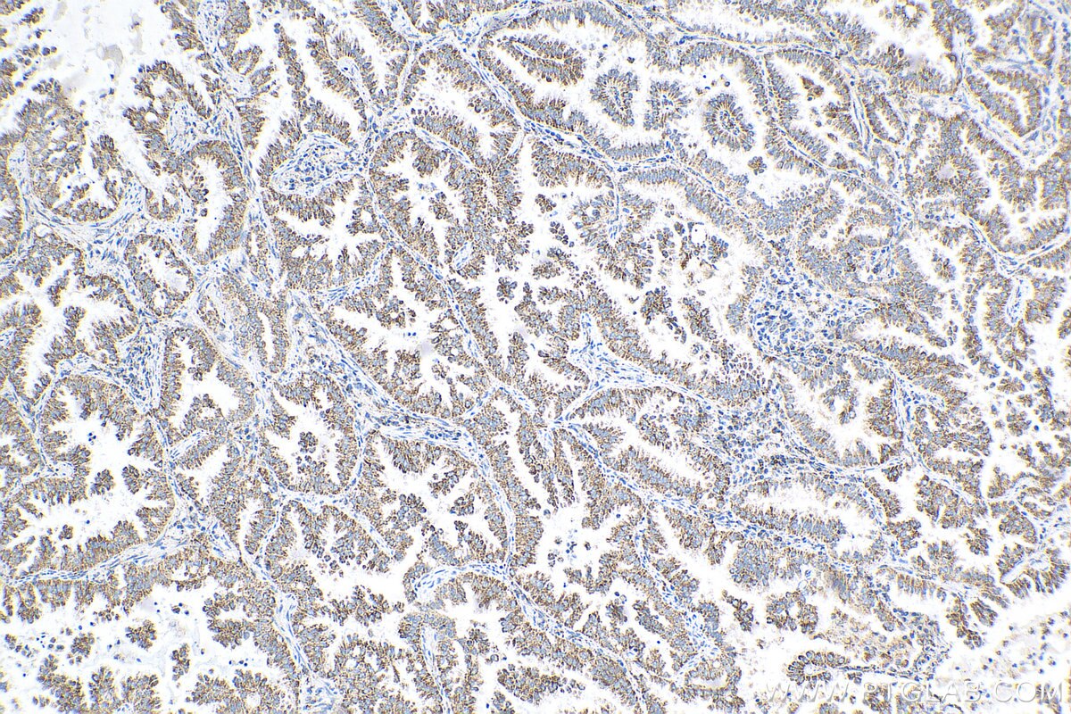 Immunohistochemistry (IHC) staining of human lung cancer tissue using NDUFV1 Monoclonal antibody (68144-1-Ig)