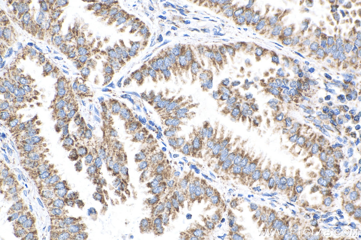 Immunohistochemistry (IHC) staining of human lung cancer tissue using NDUFV1 Monoclonal antibody (68144-1-Ig)