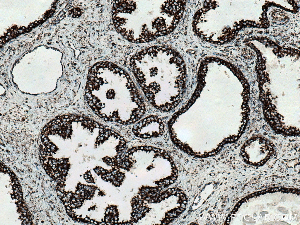 IHC staining of human prostate cancer using 15301-1-AP