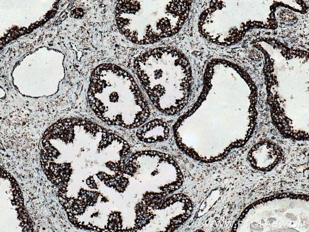 Immunohistochemistry (IHC) staining of human prostate cancer tissue using NDUFV2 Polyclonal antibody (15301-1-AP)