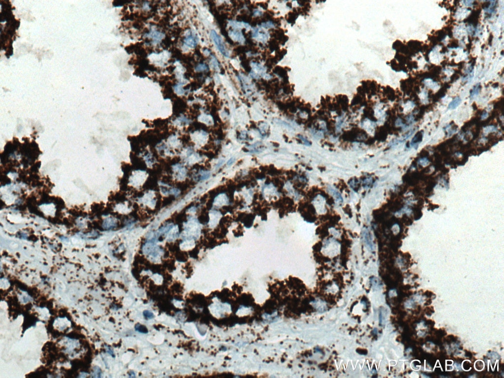 Immunohistochemistry (IHC) staining of human prostate cancer tissue using NDUFV2 Polyclonal antibody (15301-1-AP)