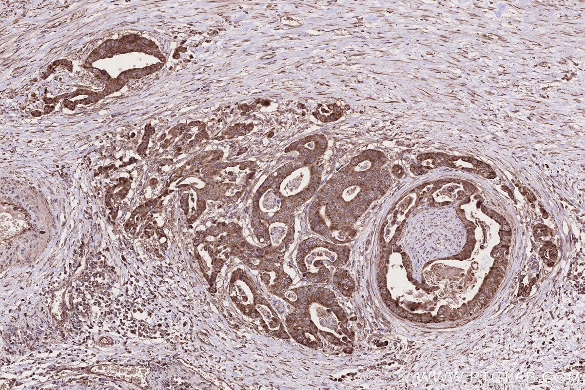 Immunohistochemistry (IHC) staining of human stomach cancer tissue using NEDD1 Polyclonal antibody (13993-1-AP)