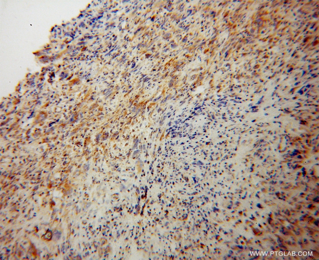 Immunohistochemistry (IHC) staining of human gliomas tissue using NEDD1 Polyclonal antibody (13993-1-AP)