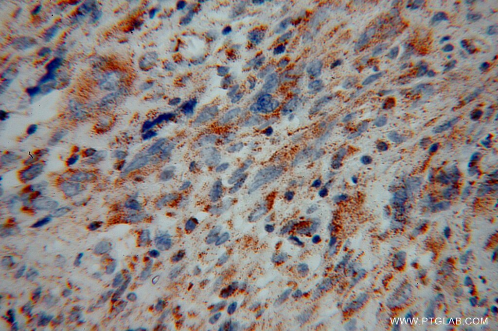 Immunohistochemistry (IHC) staining of human gliomas tissue using NEDD1 Polyclonal antibody (13993-1-AP)