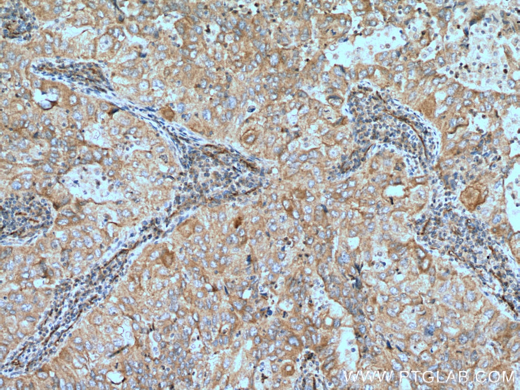 Immunohistochemistry (IHC) staining of human lung cancer tissue using NEDD4 Polyclonal antibody (21698-1-AP)