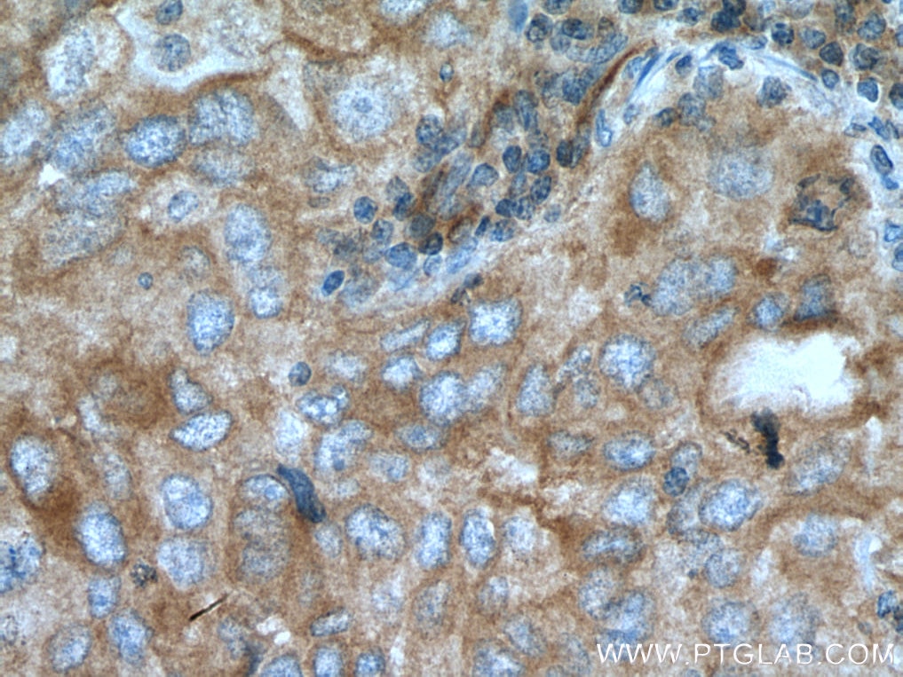 Immunohistochemistry (IHC) staining of human lung cancer tissue using NEDD4 Polyclonal antibody (21698-1-AP)