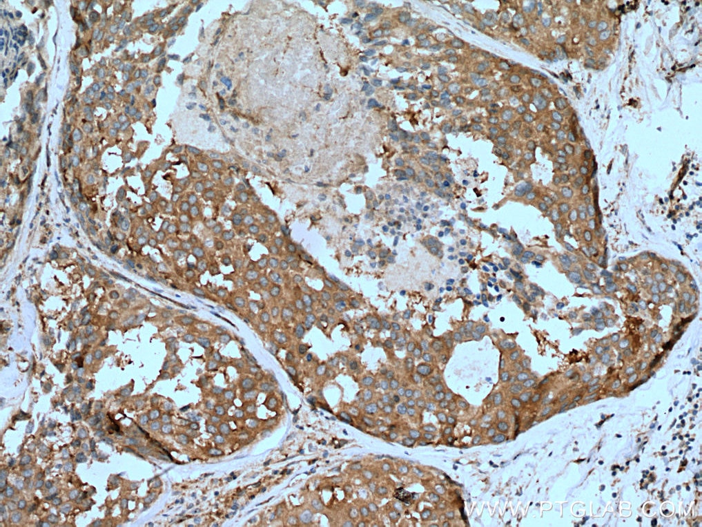 Immunohistochemistry (IHC) staining of human breast cancer tissue using NEDD4 Polyclonal antibody (21698-1-AP)