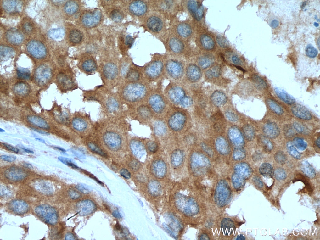 Immunohistochemistry (IHC) staining of human breast cancer tissue using NEDD4 Polyclonal antibody (21698-1-AP)