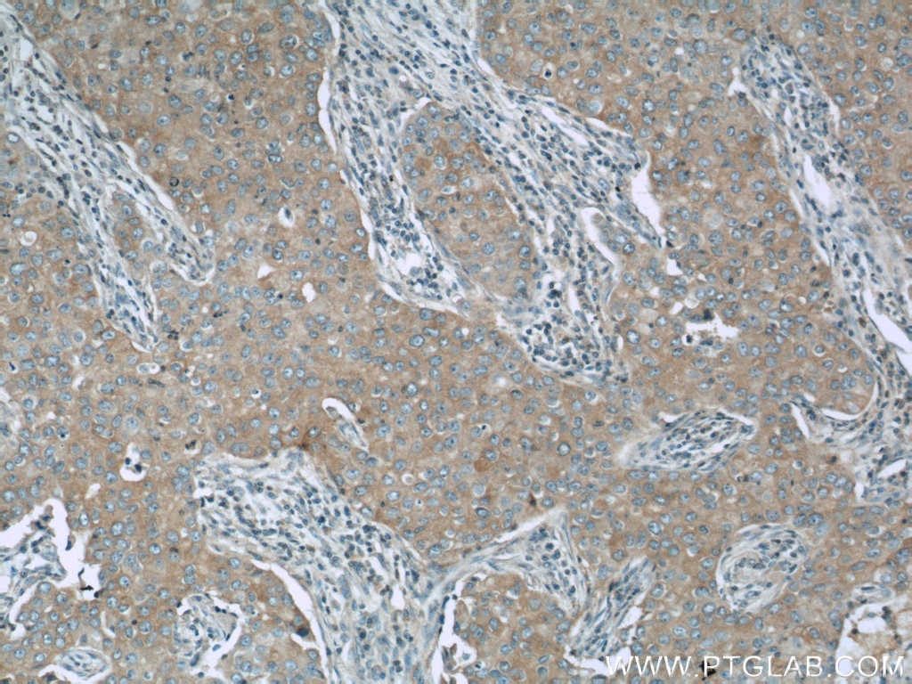 Immunohistochemistry (IHC) staining of human breast cancer tissue using NEDD4 Polyclonal antibody (21698-1-AP)