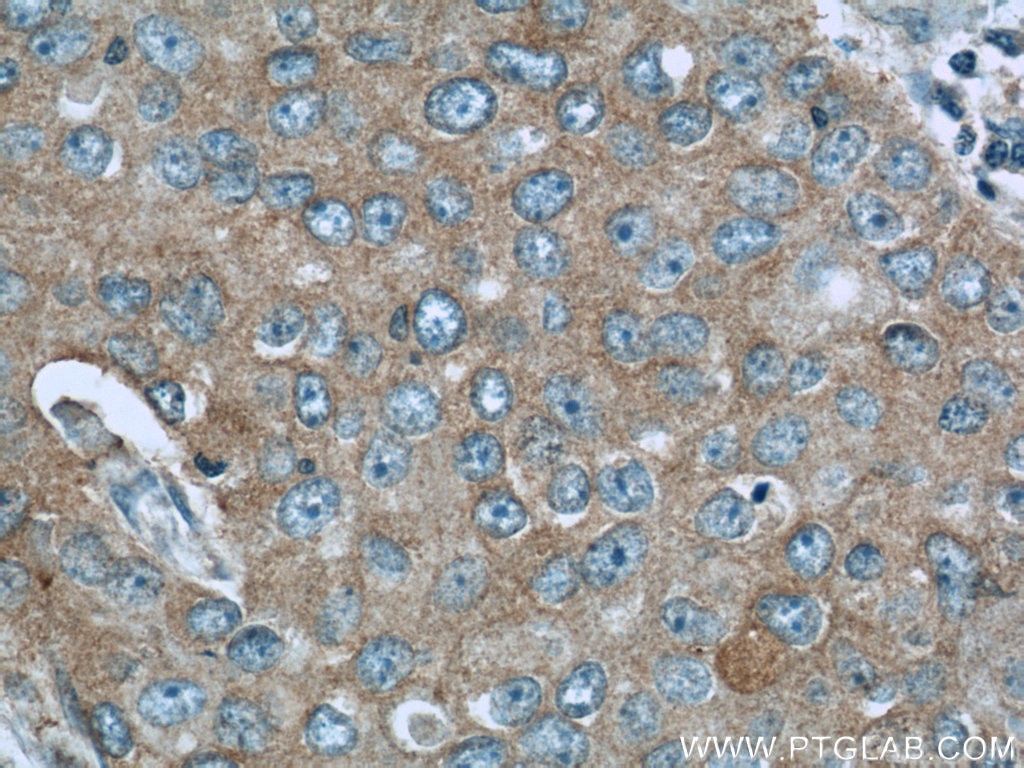 IHC staining of human breast cancer using 21698-1-AP