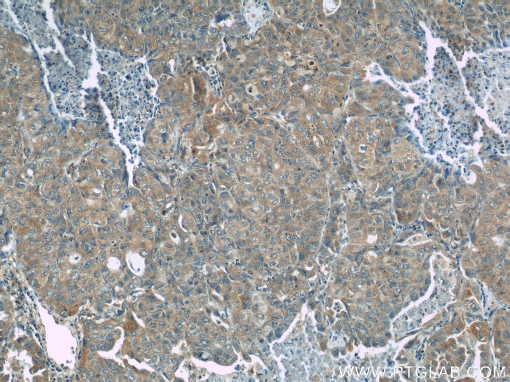 Immunohistochemistry (IHC) staining of human lung cancer tissue using NEDD4 Polyclonal antibody (21698-1-AP)