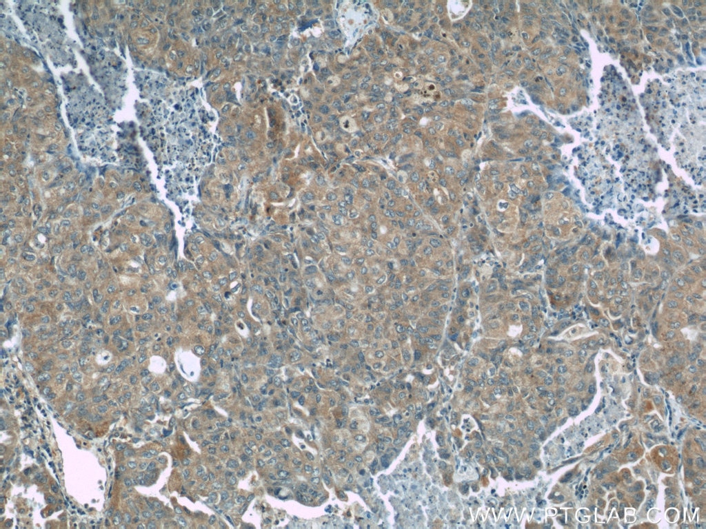 IHC staining of human lung cancer using 21698-1-AP