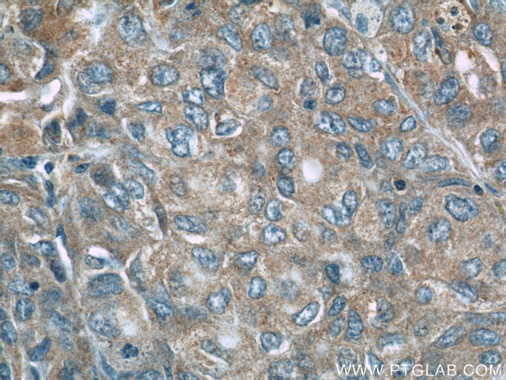 Immunohistochemistry (IHC) staining of human lung cancer tissue using NEDD4 Polyclonal antibody (21698-1-AP)