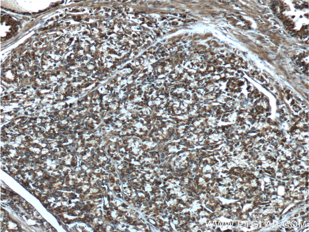 Immunohistochemistry (IHC) staining of human prostate cancer tissue using NEDD4L Polyclonal antibody (13690-1-AP)