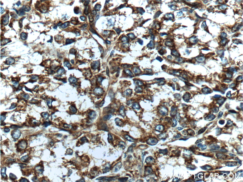 Immunohistochemistry (IHC) staining of human prostate cancer tissue using NEDD4L Polyclonal antibody (13690-1-AP)