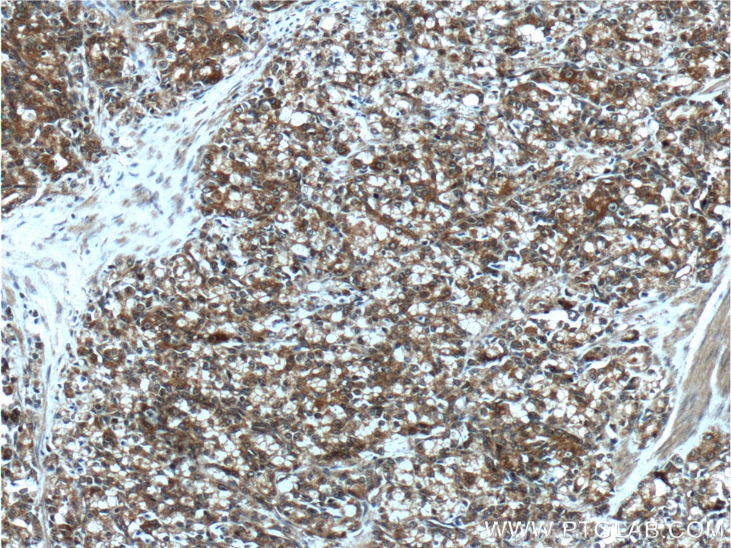 Immunohistochemistry (IHC) staining of human prostate cancer tissue using NEDD4L Polyclonal antibody (13690-1-AP)