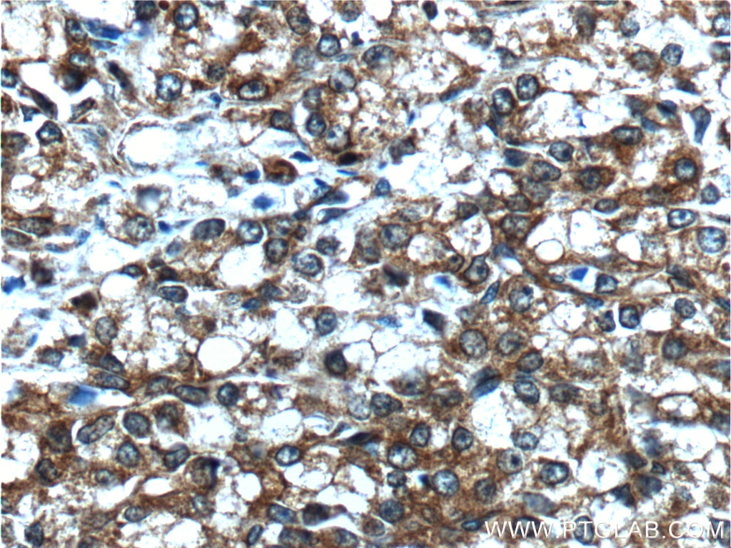 Immunohistochemistry (IHC) staining of human prostate cancer tissue using NEDD4L Polyclonal antibody (13690-1-AP)