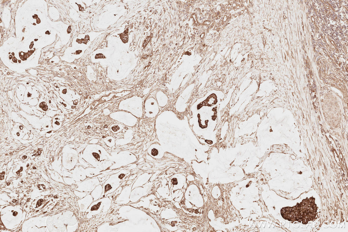 Immunohistochemistry (IHC) staining of human stomach cancer tissue using NEDD4L Polyclonal antibody (13690-1-AP)