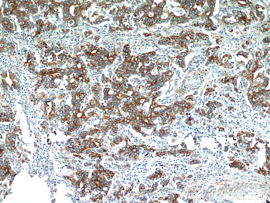 Immunohistochemistry (IHC) staining of human stomach cancer tissue using NEDD4L Polyclonal antibody (13690-1-AP)
