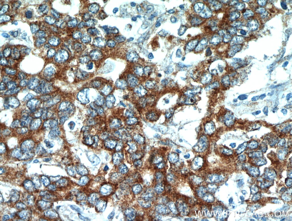 Immunohistochemistry (IHC) staining of human stomach cancer tissue using NEDD4L Polyclonal antibody (13690-1-AP)