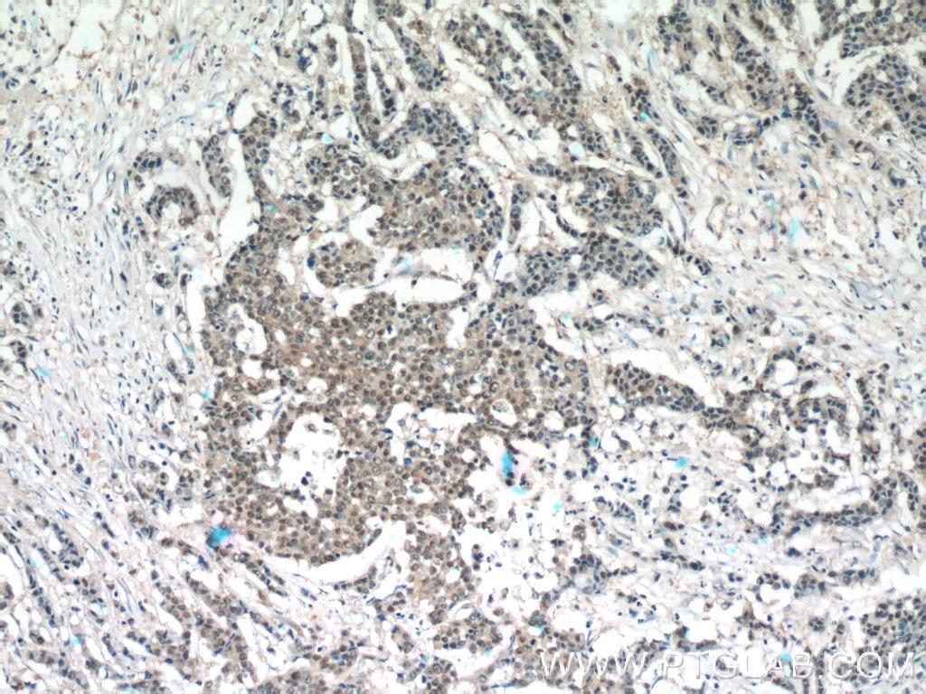 Immunohistochemistry (IHC) staining of human colon cancer tissue using NEDD8 Polyclonal antibody (16777-1-AP)