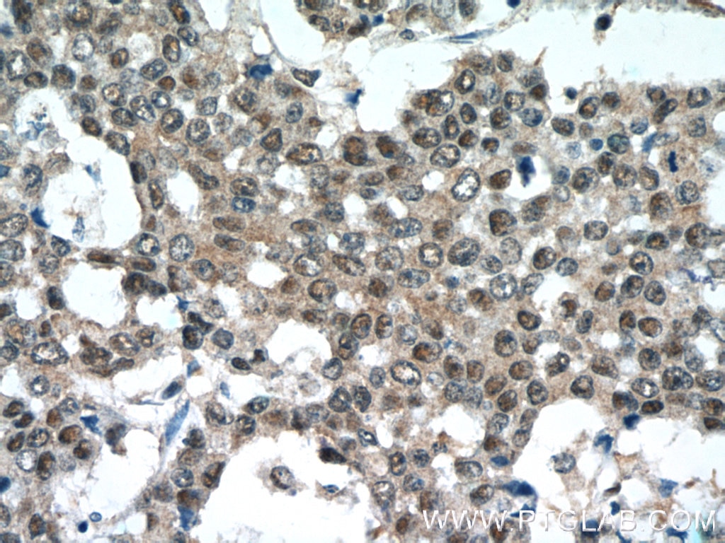 IHC staining of human colon cancer using 16777-1-AP