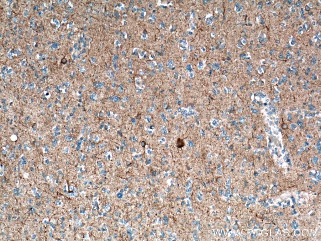 Immunohistochemistry (IHC) staining of human gliomas tissue using NF-H/NF200 Polyclonal antibody (18934-1-AP)