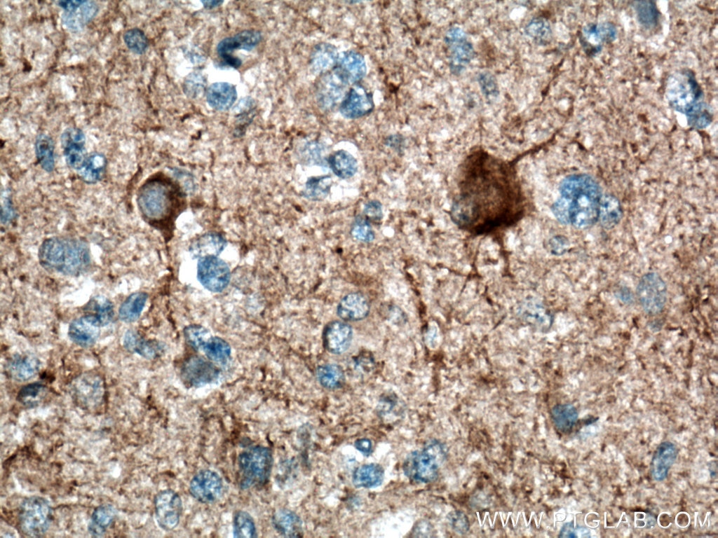 Immunohistochemistry (IHC) staining of human gliomas tissue using NF-H/NF200 Polyclonal antibody (18934-1-AP)