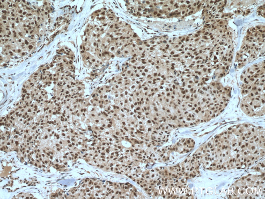 Immunohistochemistry (IHC) staining of human lung cancer tissue using NEK1 Polyclonal antibody (27146-1-AP)