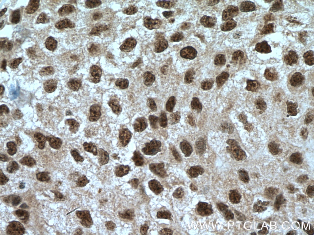 Immunohistochemistry (IHC) staining of human lung cancer tissue using NEK1 Polyclonal antibody (27146-1-AP)