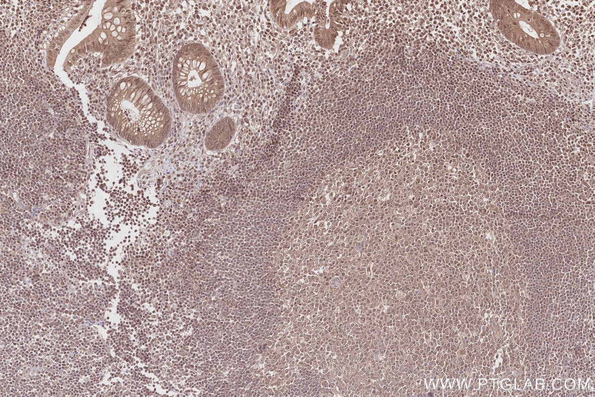 IHC staining of human appendicitis using 27146-1-AP Immunohistochemistry (IHC) staining of human appendicitis tissue using NEK1 Polyclonal antibody (27146-1-AP)