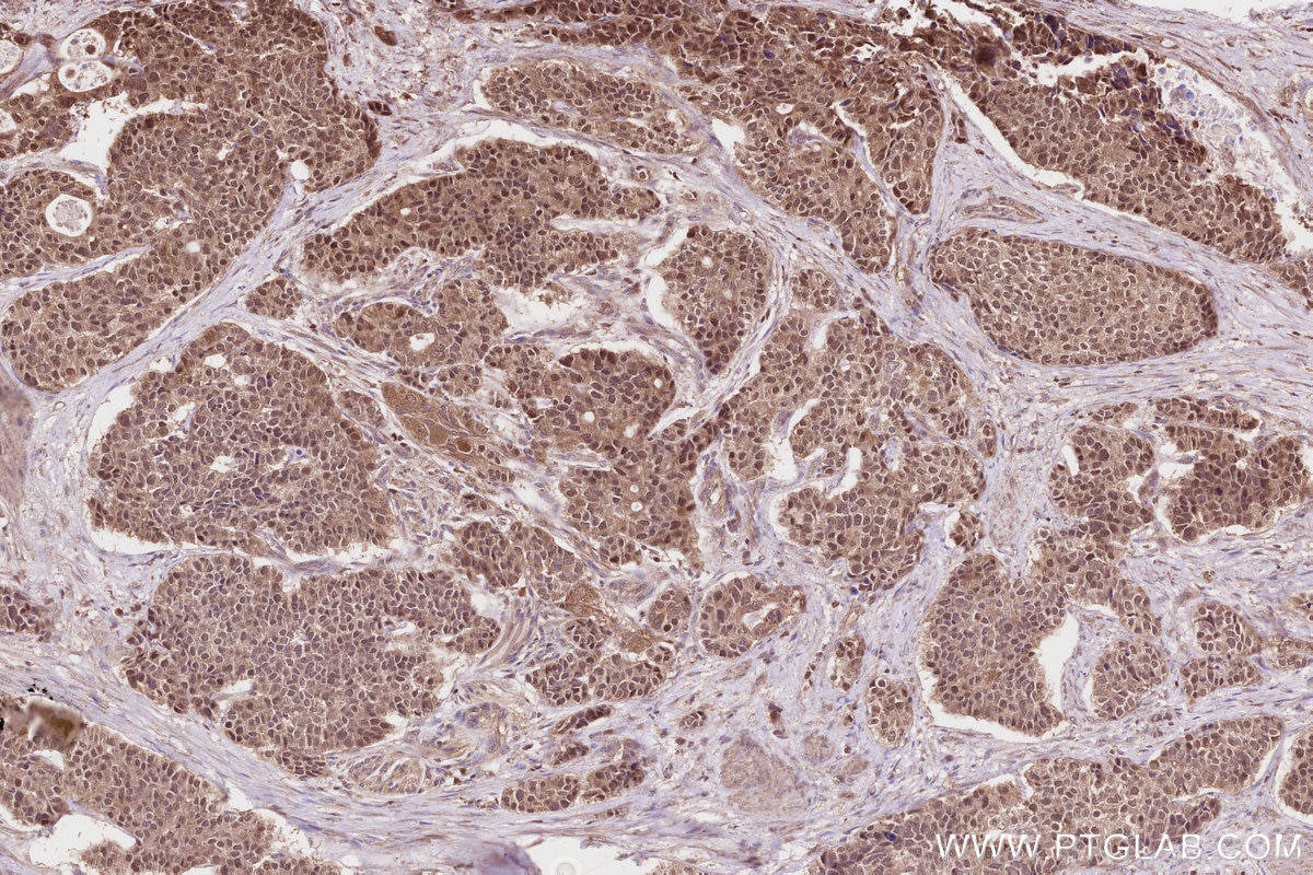 IHC staining of human stomach cancer using 27146-1-AP Immunohistochemistry (IHC) staining of human stomach cancer tissue using NEK1 Polyclonal antibody (27146-1-AP)