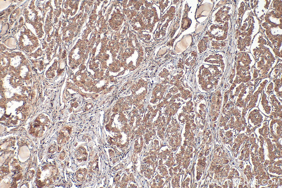 Immunohistochemistry (IHC) staining of human thyroid cancer tissue using NEK5 Polyclonal antibody (26254-1-AP)