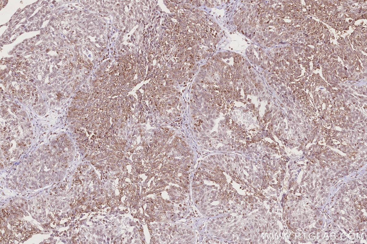 Immunohistochemistry (IHC) staining of human ovary cancer tissue using NEK7 Polyclonal antibody (31422-1-AP)