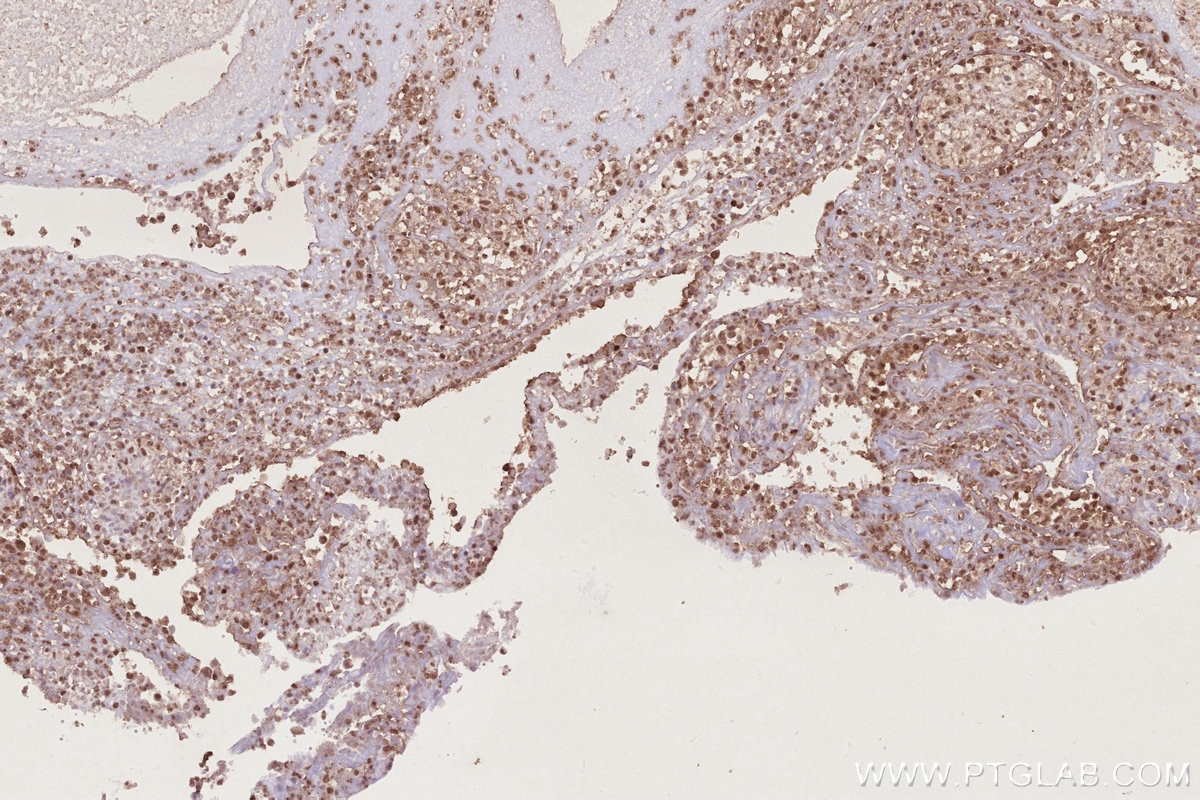 Immunohistochemistry (IHC) staining of human ovary cancer tissue using NEK7 Polyclonal antibody (31422-1-AP)